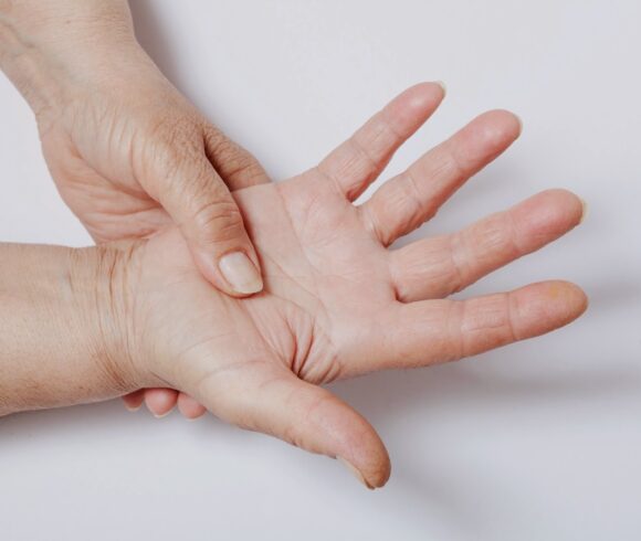 Il lupus colpisce frequentemente  le articolazioni delle mani